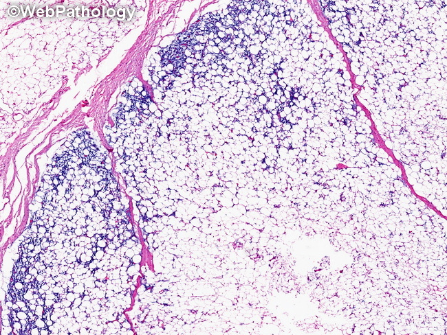 Soft Tissue_Lipomatous_Lipoblastoma31_resized.jpg
